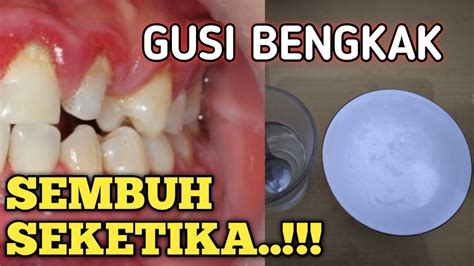 Jantung bengkak ini memang sangat berbahaya dan merupakan salah satu penyakit yang beresiko memicu kematian. OBAT GUSI BENGKAK PALING AMPUH!! Cara Mengobati Gusi ...