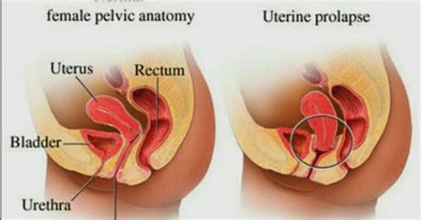 Turun peranakan atau istilah medisnya prolaps organ panggul bisa terjadi pada semua wanita di usia berapa pun.  Ibu Hamil  Cara Kesan Peranakan Jatuh, Punca Dan Cara ...