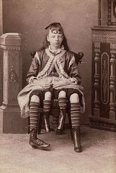 This referred to the fact that she had two separate pelvises side by side from the waist down, as a result of her body. File:Myrtle Corbin.jpg - Wikimedia Commons