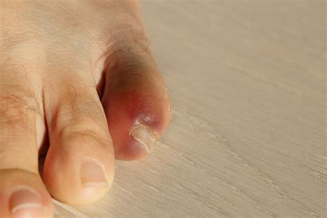 Broken toe: Symptoms, pictures, and treatment