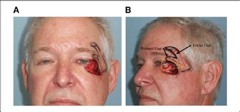 Official publication of the association of plastic surgeons of india, volume 47.abstractnone. A and B, Preoperative frontal and oblique views of the eyelids defect... | Download Scientific ...