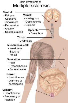 However, some tests are helpful and may indicate that ms is a possible, or probable, cause of the symptoms. Multiple sclerosis - Wikipedia