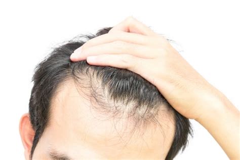 I witnessed firsthand how challenging hair loss can be to the psyche and wanted to learn more about the available hair loss solutions. Hereditary Hair Loss Explained | Viviscal Healthy Hair Tips