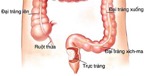 Điều đặc biệt là những trang bị của chúng ta sẽ có 2 phiên bản. Viêm đại tràng xích ma là gì? Triệu chứng và cách điều trị