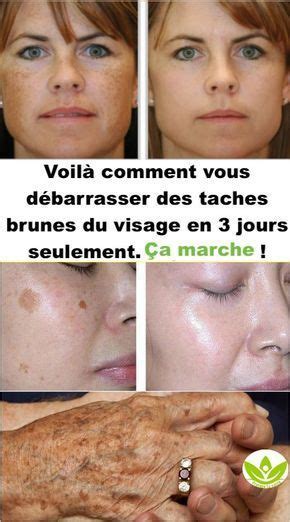 Mais les taches brunes se remarquent souvent plus que les autres. COMMENT éliminer les taches brunes sur le visage et les ...