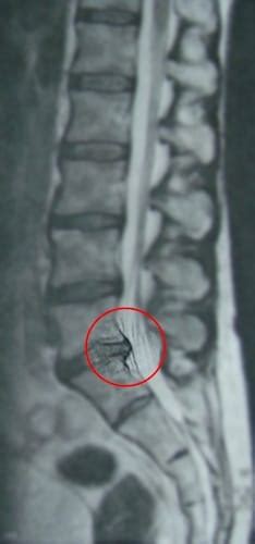 E it oft auf der rückeite der augen zentriert, it aber normalerweie chwer von anderen arten von kopfchmerzen zu. Lumbaler Bandscheibenvorfall | Institut Chiari ...