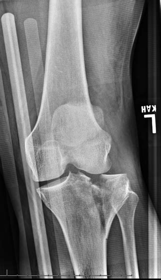 Tibial plateau fractures signify periarticular fractures of the proximal tibia frequently associated with soft tissue injuries. Ortho Blog - CMC COMPENDIUM