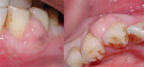 Pus pocket on the gums, commonly known as gum abscess and medically known as periodontal abscess, is a condition where there is localized inflammation with formation of pockets of pus in the tissues (periodontal tissues) which support our teeth. Odontogene Infektion - Wikipedia
