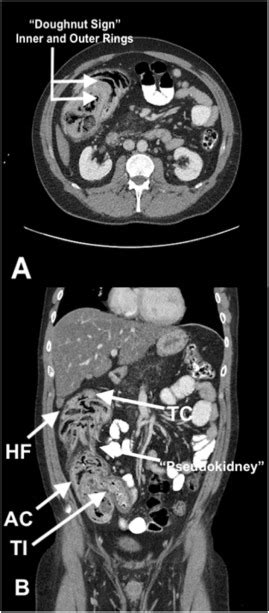 Intussusception is a medical emergency and should be take seriously. Colocolonic intussusception in an adult cystic fibrosis ...