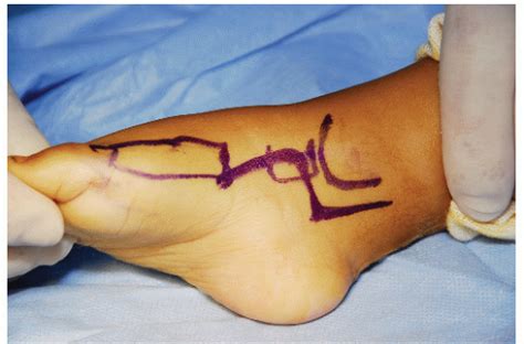 Check spelling or type a new query. Clubfoot | Musculoskeletal Key