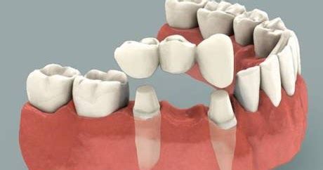 Mulai dari yang lepasan, permanen, akrilik, valplast puri dental clinic menyediakan jasa pemasangan gigi palsu yang langsung dikerjakan oleh tenaga dokter gigi profesional di klinik kami. Biaya , Harga Gigi Palsu , Pasangnya yang Bagus dan Murah ...