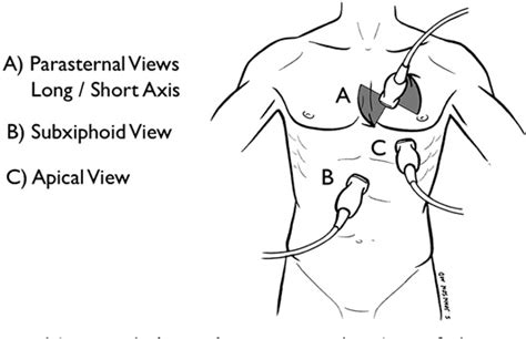 The heart portion of the rush exam evaluates for pericardial effusion and tamponade, right ventricular failure as a sign of pulmonary embolism and a qualitative assessment of left ventricular function. Figure 1 from The RUSH exam: Rapid Ultrasound in SHock in ...