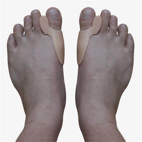 Ревматоидный артрит как похудеть