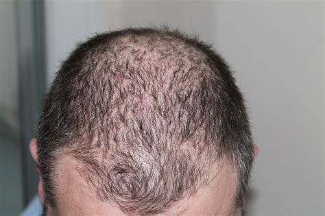 A study showed that as smoking tobacco may destroy hair follicles extensively, and it may increase the risk of hair loss. Hair Loss Clinical Trials | Clinical Trials GPS