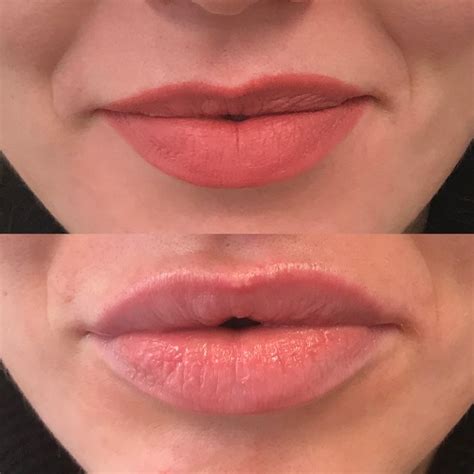 All your burning edibles questions, answered. Lip Fillers Altrincham & Cheshire - Revolution Aesthetics