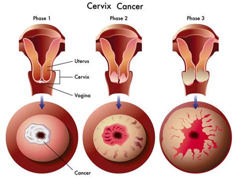 Symptoms and signs of cervical cancer include: What is Pap Smear Test?Know the Procedure & Prices in India