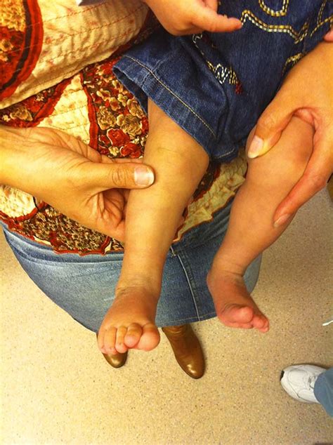 Idiopathic (unknown cause) also known as talipes equinovarus, idiopathic clubfoot is the most common type of clubfoot and is. Baby Clubfoot Journey | Southern California Foot & Ankle Specialists