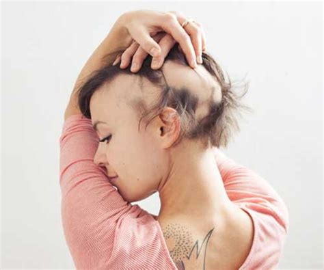 Here are few ways to reverse hair loss caused due to malnutrition. Hair Loss In Women: What You Should Know