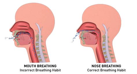 Nasal polyps (np) are noncancerous growths within the nose or sinuses. Mouth breathing vs Nasal breathing