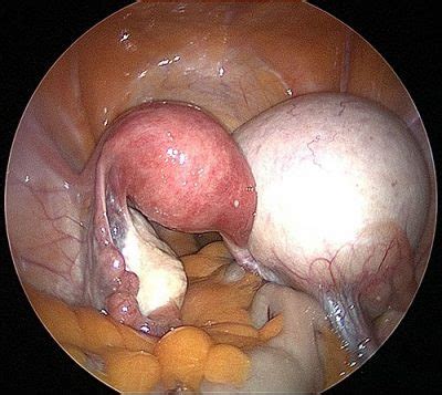 Ovarian cyst pelvic ultrasound female. How Do They Drain A Cyst On The Ovary - Best Drain Photos ...