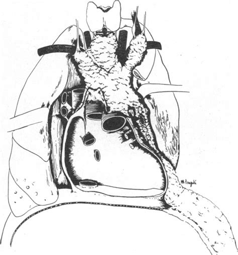 Myasthenia gravis results from an autoimmune attack on postsynaptic acetylcholine receptors, which disrupts neuromuscular transmission. Remdesivir In Myasthaenia Gravis / Everything You Need To ...