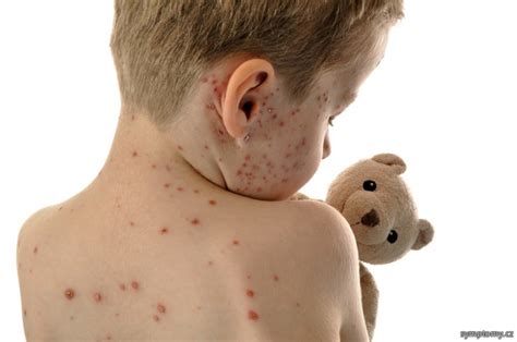 Potřebuji co nejvíce podrobností :help: Neštovice - příznaky a léčba