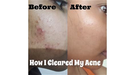 Pcos, akne ve akne tedavisi hakkında bilinmesi gerekenler. How I Cleared My Acne ( PCOS / PCOD ) | Tips That Actually ...