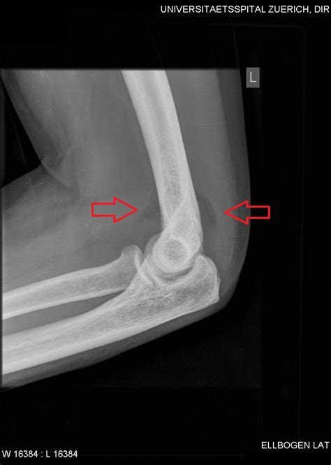 In children, a posterior fat pad sign suggests a condylar fracture of the humerus. File:CR. Anterior and posterior fat pad sign..jpg ...