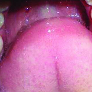 The results revealed that the mesiopalatal canals were present in 56.25% of the sections at 6mm from the root apex, and in 23.75% at 3mm from the apical limit. Oblique fracture of distofacial cusp with 16 with loss of ...