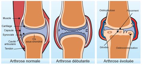 Le soins des mains doit être tout aussi important que le reste du corps. Arthrose Chronique : Arthrose Genou | Douleur de Genou