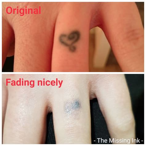 Laser tattoo removal works by firing laser light right into the tattoo which shatters the ink into very small pieces, these little pieces are very easy for the body to absorb. Dark finger tattoo | Laser tattoo removal, Laser tattoo ...