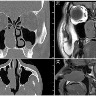 In the absence of bone. (PDF) Isolated craniopharyngioma in the nasal cavity