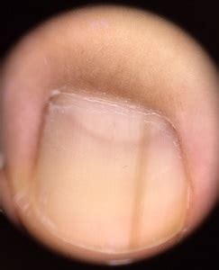 Q11爪の切り方 爪を短く切るのは良くないと言われましたが、本当ですか。 q1250歳、女性ですが、足の親指の爪が濁って、分厚くなり、曲がって生えています。 靴を履くと痛みがあります。 q13爪表面の小さい凹み 指爪の表面に小さい凹みが次々と現れてきま. 爪の黒い線 :皮膚科医 梶澤知恵子 マイベストプロ富山