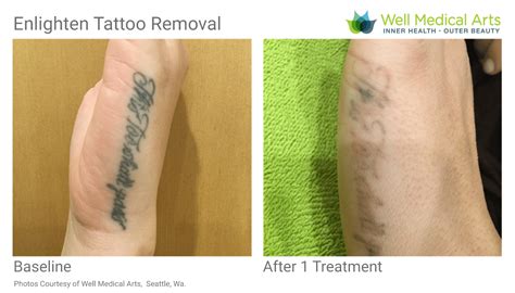 How much does laser tattoo removal cost in seattle? Tattoo Removal in Seattle using Pico Technology at Well ...