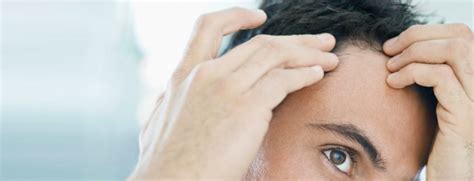 Bei kahlen stellen auf dem kopf sprechen viele gründe für eine haarverpflanzung Wann ist eine Haartransplantation sinnvoll - Die Phasen ...