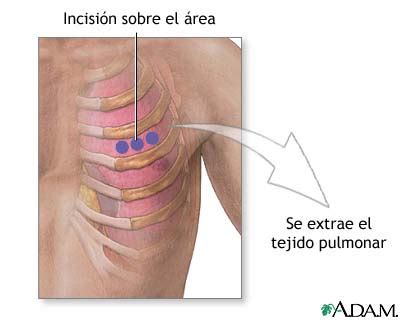 Mi mamá no le gusta la limpieza. Incisión para biopsia de pulmón: MedlinePlus enciclopedia ...