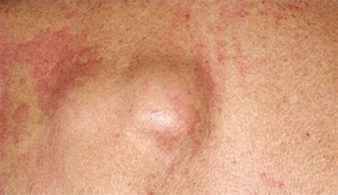 Aside from the expensive medical and/or treatment procedures, there are still no medicines or methods that could guarantee 100% cure or relief from this disease. Do You Know These 14 Lung Cancer Symptoms? - Page 4