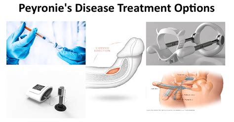 Our hair loss treatment & hair transplant clinic located in gurgaon delhi ncr is easily accessible. Peyronie's Disease Treatment in New Delhi India | Options ...