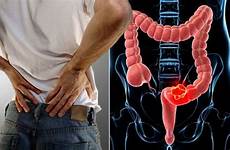 bowel passage tumour anus abdomen ignore