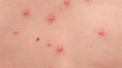 Cacar air adalah penyakit yang disebabkan virus varicella zoster yang merupakan keluarga virus herpes. Ciri-ciri Penyakit Cacar Air, Manusia Pasti mengalaminya ...