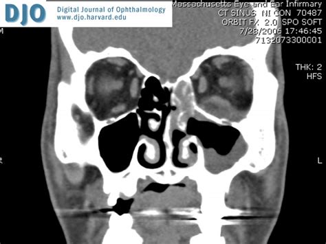 Infection often occurs initially in the upper nasal turbinates or nasal sinuses, as well as the palate and pharynx. DJO | Digital Journal of Ophthalmology