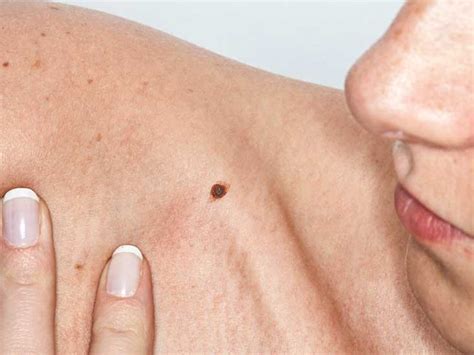 A reddish, velvety rash under the foreskin. Skin Cancer Pictures and Facts: What You Need to Know