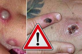 Doctors can distinguish monkeypox from other diseases through different symptoms, but one of the primary ways to notice it is the swollen lymph nodes. Monkeypox virus outbreak in UK: Second case confirmed ...