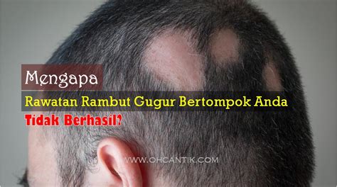 Sebuah hub rawatan islam yang pertama di singapura. Punca Rawatan Rambut Gugur Bertompok Tak Berhasil ...