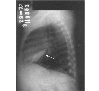 La bronquitis aguda desaparece después de algunas semanas pero la bronquitis crónica dura meses y puede ser grave. Pneumonia Lobar — Atlas Virtual e Interativo de Morfologia ...