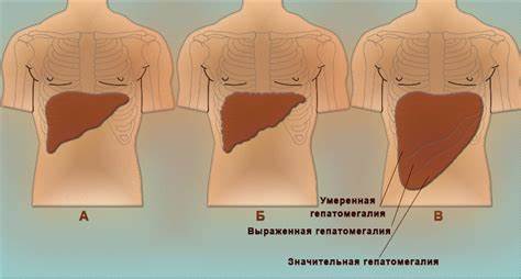 Печень лечение диета увеличенная причины Увеличенная печень фото живота: Цирроз печени – первые признаки Увеличенная печень фото живота: Цирроз печени – первые признаки Печень лечение диета увеличенная причины