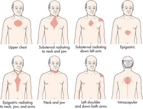 Melanomas typically occur in the skin but may rarely occur in the mouth, intestines or eye (uveal melanoma). Pin on Nursing School & EMT Stuff