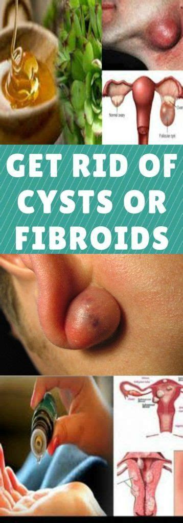 Apply apple cider vinegar on the affected area with the help of a cotton ball. HOW TO GET RID OF CYSTS OR FIBROIDS | Fibroids, Health ...