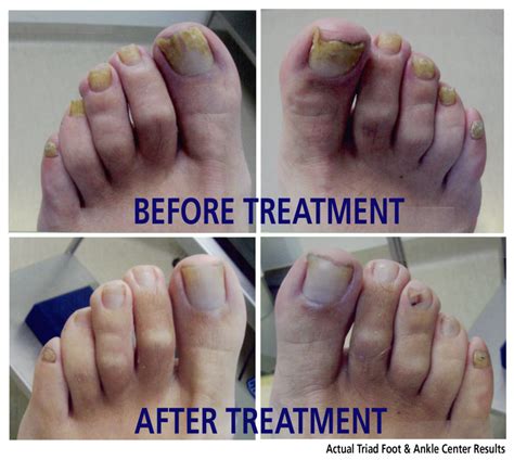 1000's got rid of their toenail fungus with this simple treatment. Triad Foot & Ankle Center