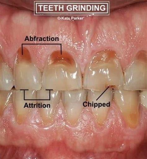 Although there are some valid reasons listed in some of the answers, more likely you are referring to a form of orofacial dyskinesia or dystonia that is often related to meds used on people with senile dementia or alzheimer's. How to Stop Grinding Your Teeth - HealthProAdvice